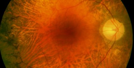 Retinitis Pigmentosa Augenoptiker Kontaktlinsenspezialist Optometrie